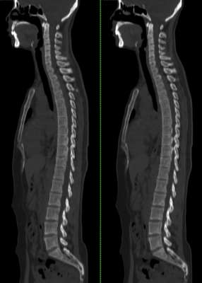 脊椎图片(强直性脊柱炎到底是啥样？几张影像片清楚地告诉你)